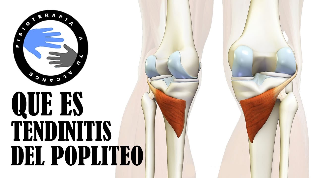 Lesiones detrás de la rodilla en España: causas, síntomas y cuándo ir al médico